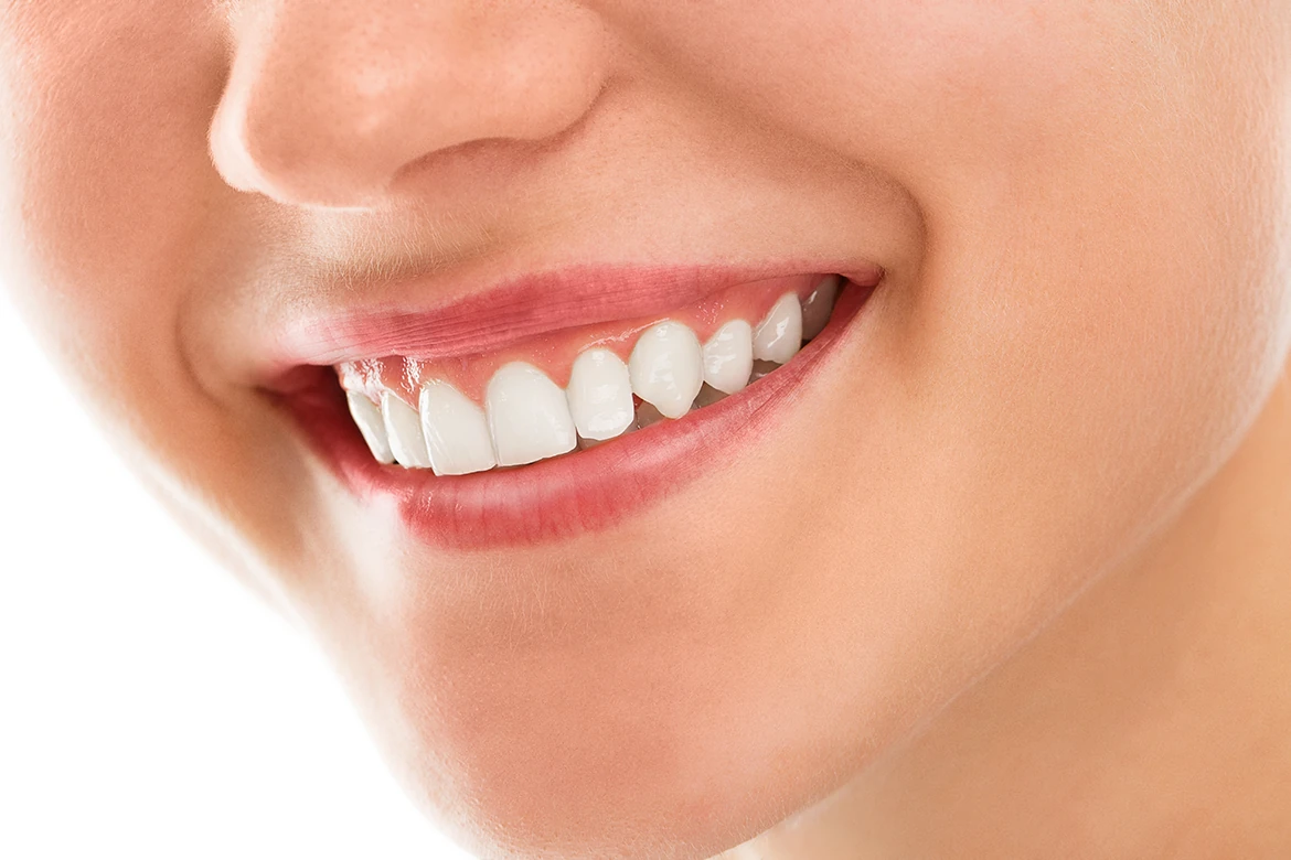 Sbiancamento dentale professionale in studio